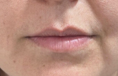 Before - Oatlands Aesthetics