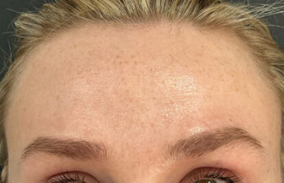 Before - Oatlands Aesthetics