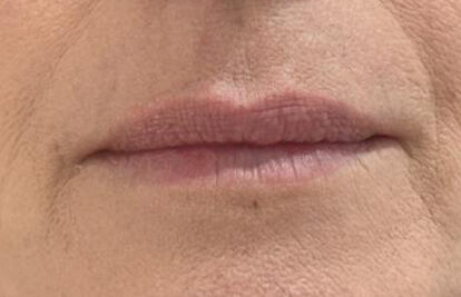 Before - Oatlands Aesthetics